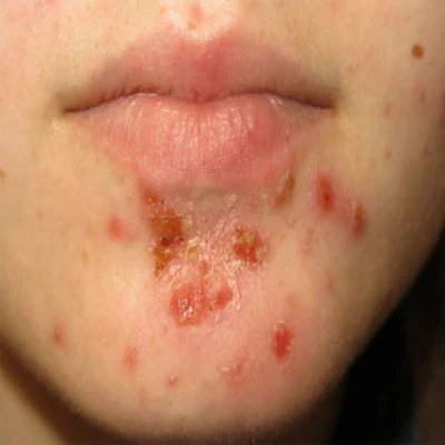 All you need to know about impetigo