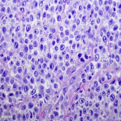 multiple myeloma review