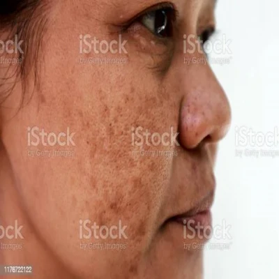 pigmentation around mouth